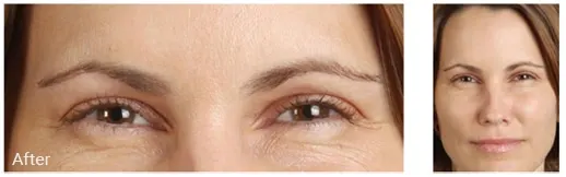 After blepharoplasty