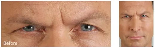 Before blepharoplasty