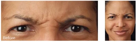 Before blepharoplasty