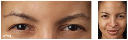 After blepharoplasty