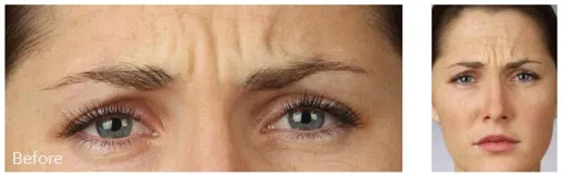 Before blepharoplasty