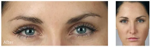 Before & After Image of BOTOX Cosmetics Hollywood FL