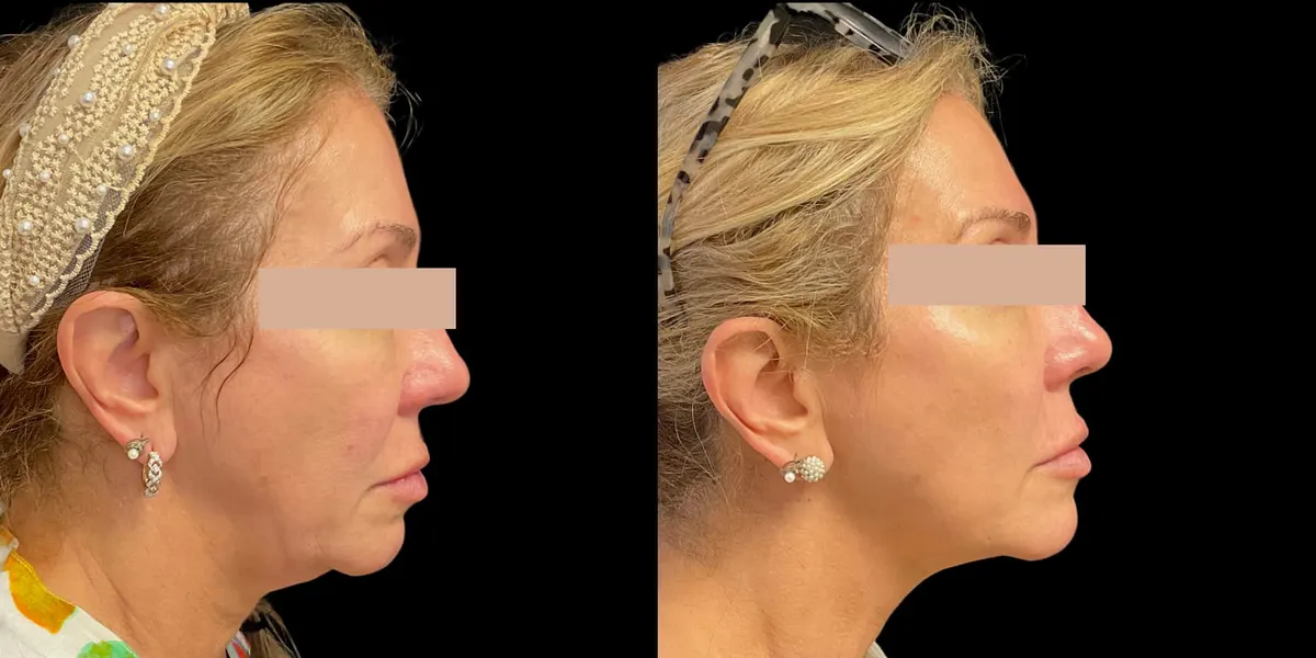 Before & After Face Morpheus Hollywood FL