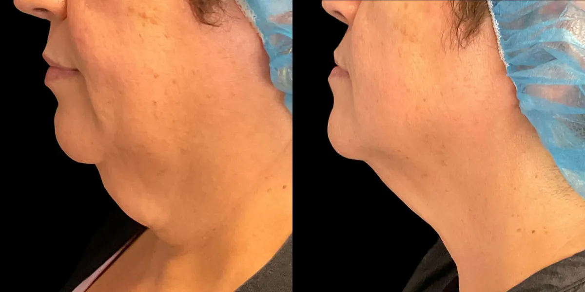 Before & After Morpheus Neck Broward County FL