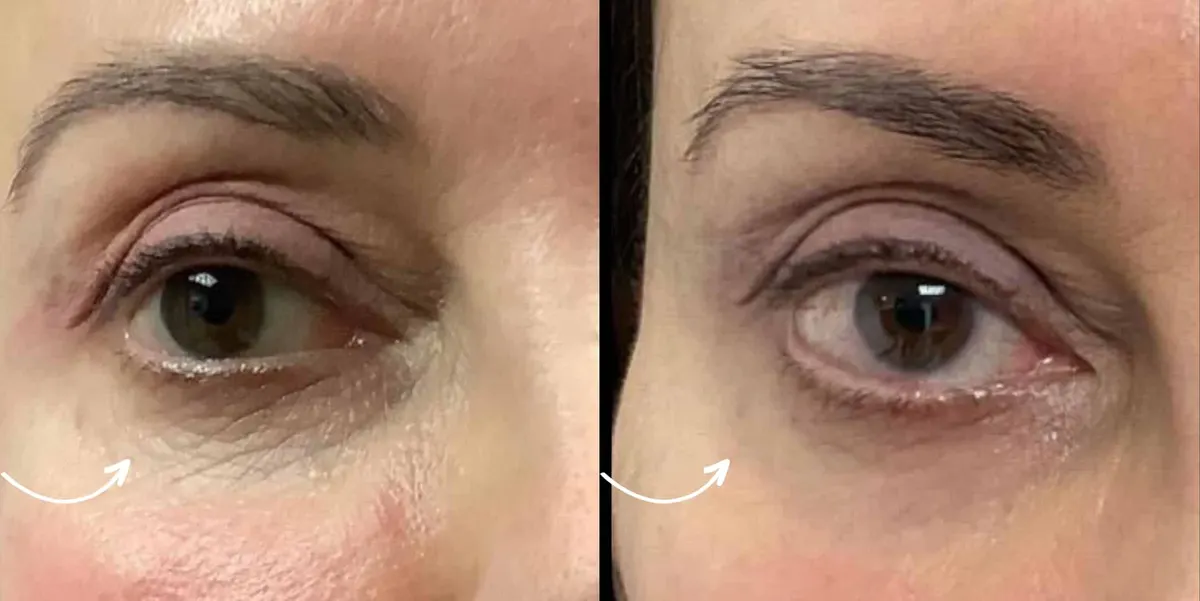 Before & After Morpheus8 Undereye Broward County FL