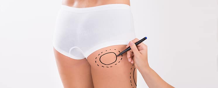 A hand marking circles on a woman's thigh with a black pen, in white shorts
