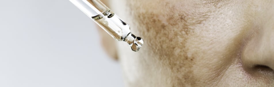 Close-up of brown patches on a woman's cheek with a clear dropper held above the skin