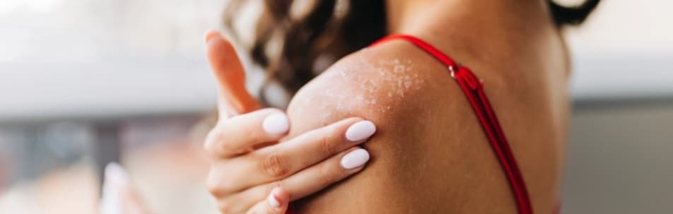 A woman touching her shoulder, which shows dry, flaking patches of skin
