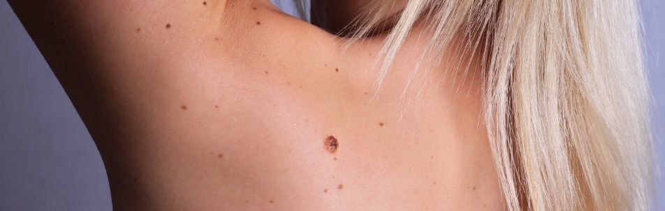 A woman's bare back and shoulder with several small moles and one larger brown mole