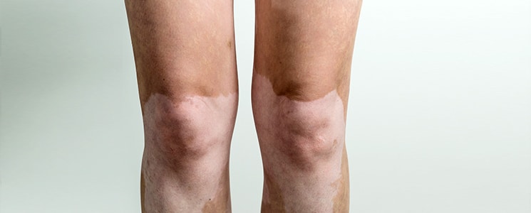 image of knees with melasma - hyperpigmentation south florida