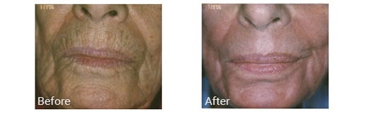 older woman’s mouth area before and after CO2 laser treatment with less lines after treatment