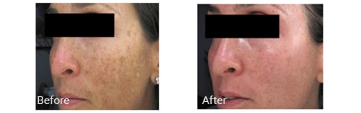 before and after fraxel laser treatment