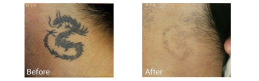 best laser tattoo removal in miramar u0026 hollywood fl best laser tattoo removal in miramar u0026 hollywood fl