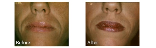 Mouth before and after Juvederm