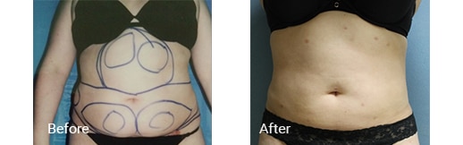 stomach before and after tumescent liposuction