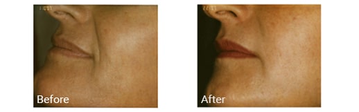 Mouth before and after Juvederm treatment