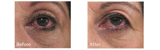 Left Eye before and after a blepharoplasty