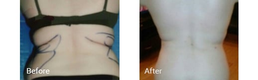 before and after of back of body contouring