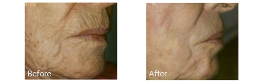 older woman’s mouth area before and after CO2 laser treatment with less lines after treatment