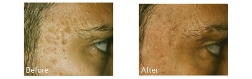 before and after fraxel laser treatment
