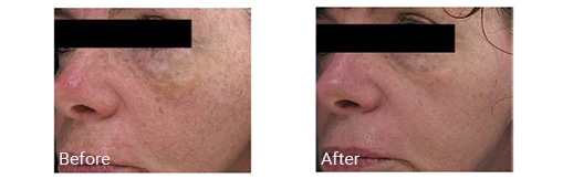 before and after IPL treatment