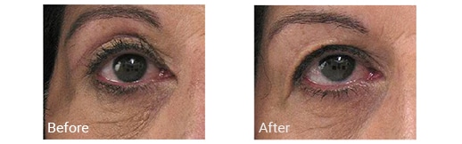 Right Eye before and after a blepharoplasty