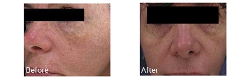 before and after IPL treatment