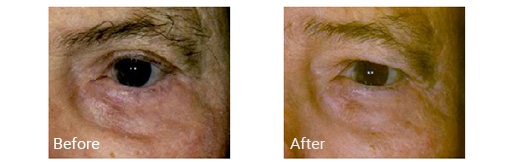Left eyelid before and after blepharoplasty