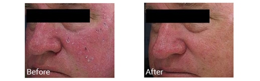 before and after Intense pulsed light treatment