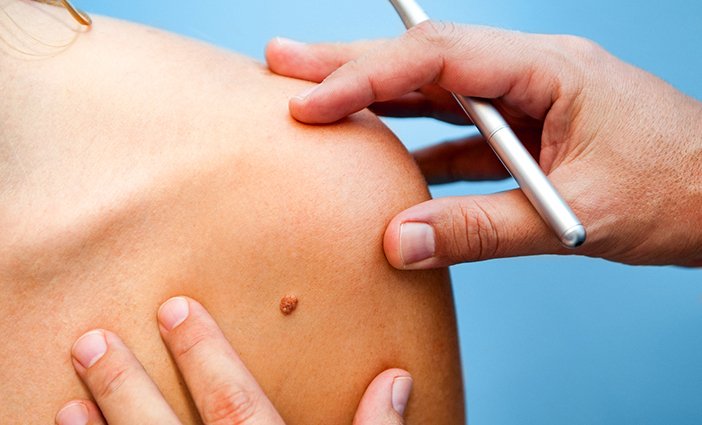 mohs surgery