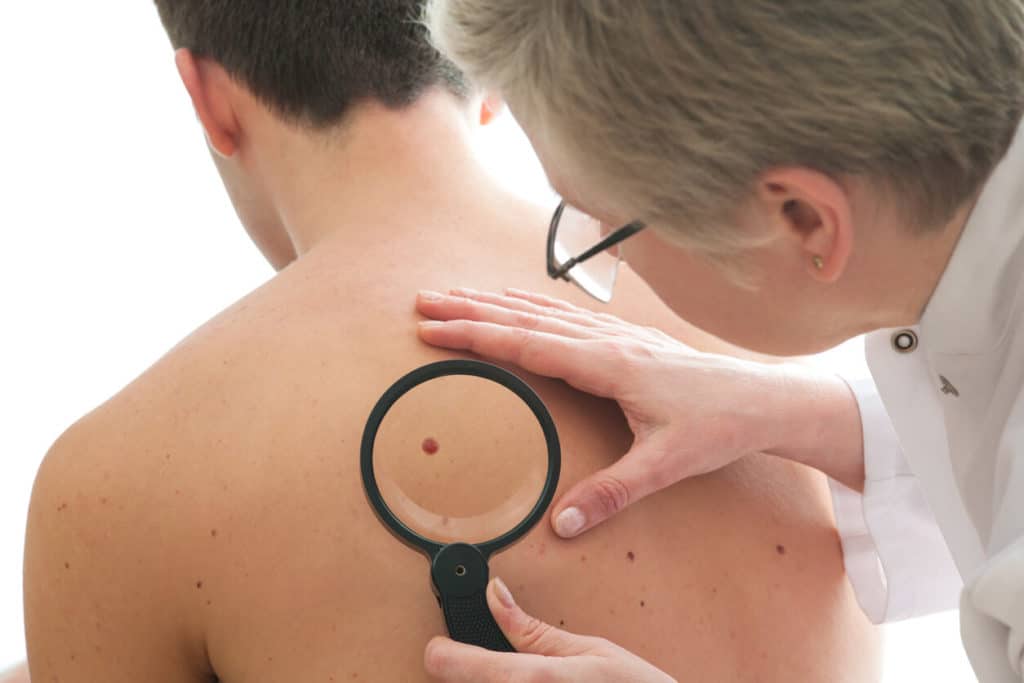 skin cancer exam