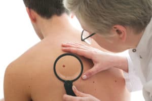 skin cancer exam