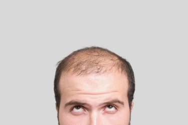 PRP for Hair Loss