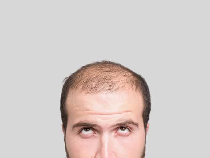 PRP for Hair Loss