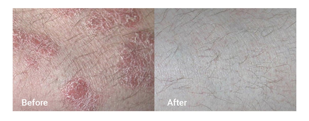 before / after photos after using XTRAC laser treatment