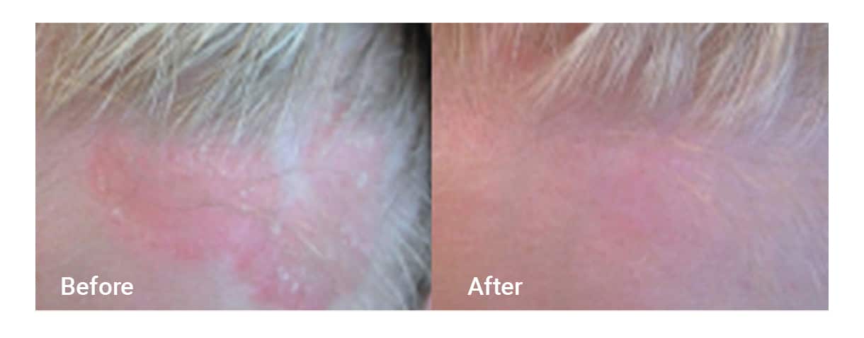 before / after photo on scalp after using XTRAC laser treatment