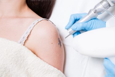 woman getting laser tattoo removal
