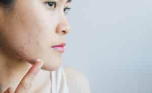 Portrait of young Asian woman having acne problem.