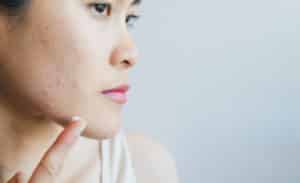 Miami Peel Treatment in Hollywood, FL Hollywood Dermatology 1