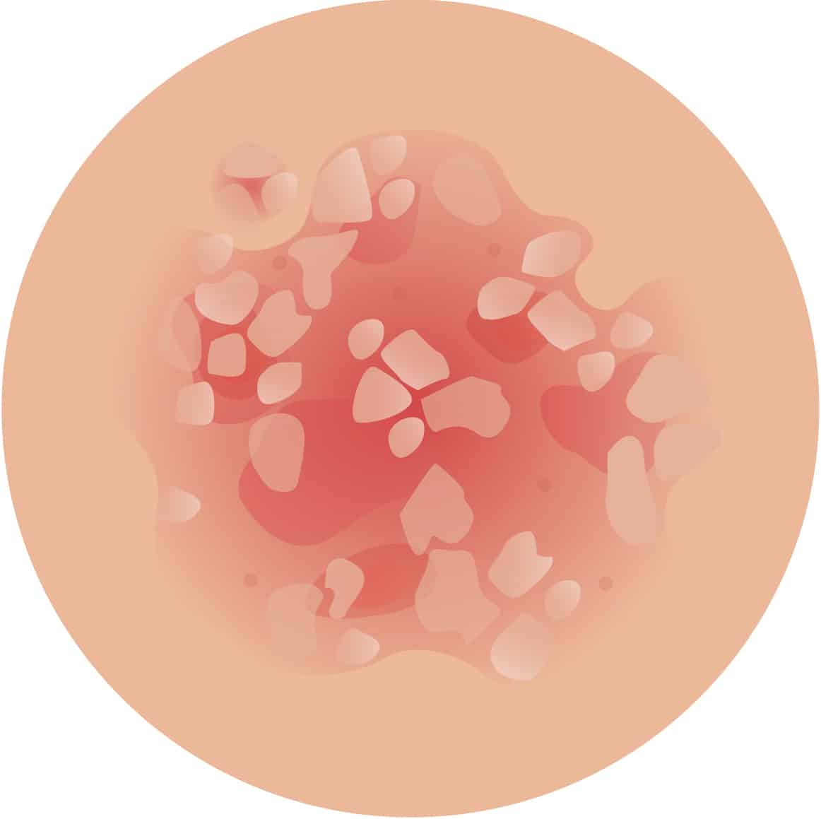 iStock 1126111641 1 psoriasis