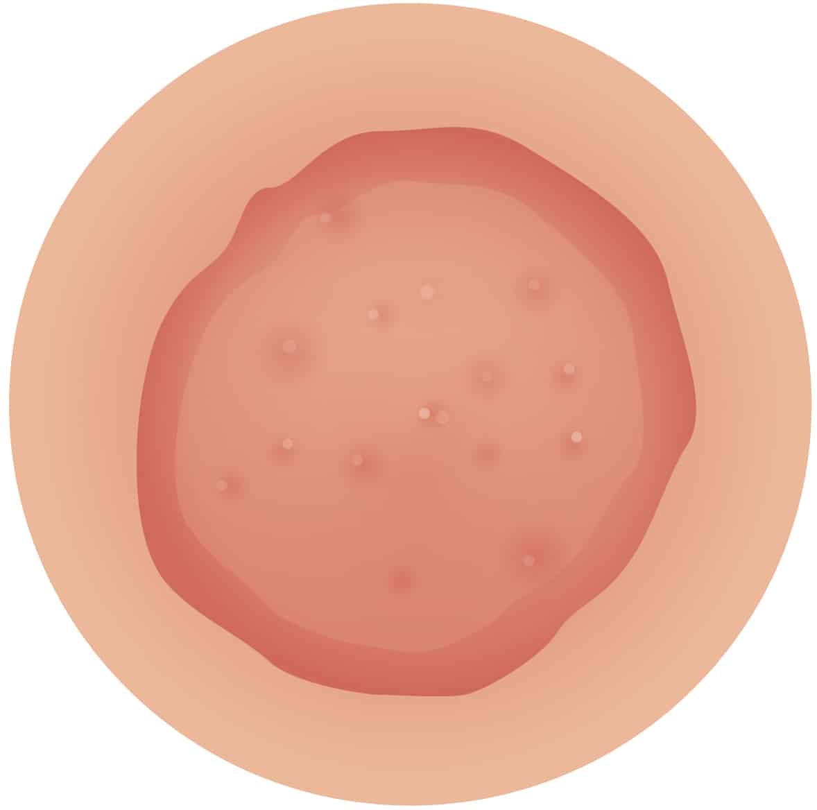 iStock 1126111641 eczema