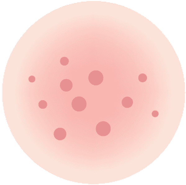 iStock 614021632 melasma