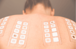 Allergy patch test on the back of a young woman