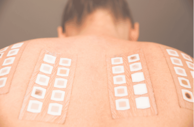 Allergy patch test on the back of a young woman