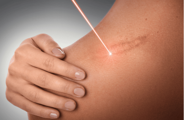 Female shoulder and laser beam during scar removal treatment