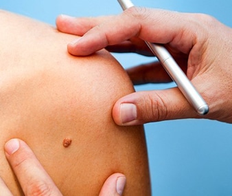 Mohs Surgery