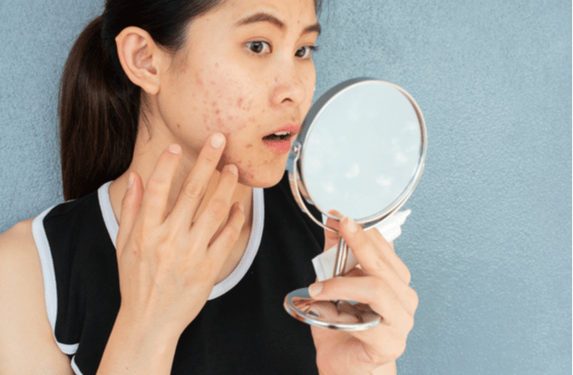 woman worry about her face when she saw the problem of acne inflammation