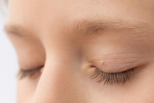 girl with papillomas on skin around eye