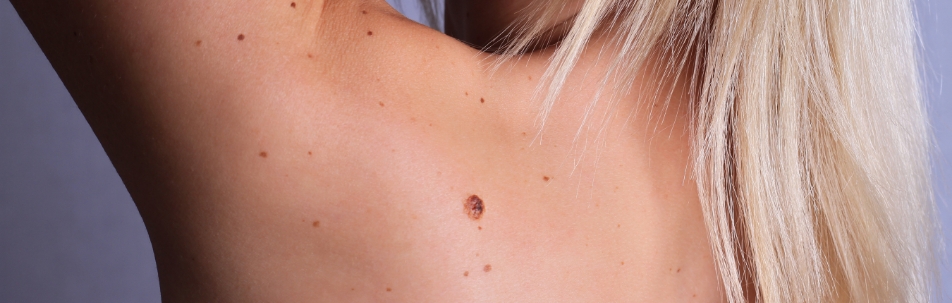 Mole Mapping for Skin Cancer Detection