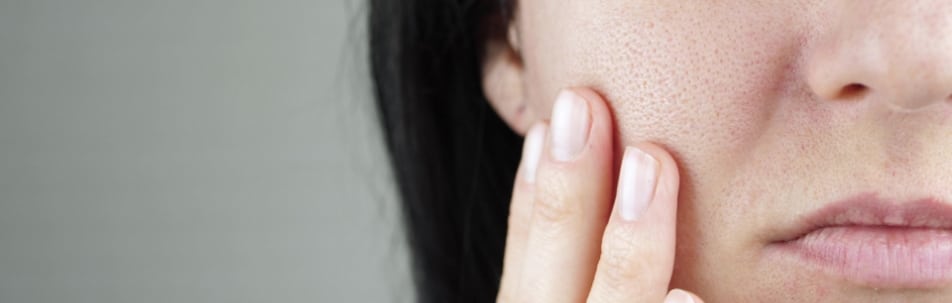 up close of woman’s cheek with acne scars